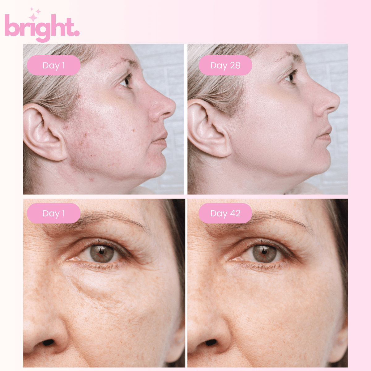 Before and after of women using the LED redlight therapy wand, showing less acne and smoother skin